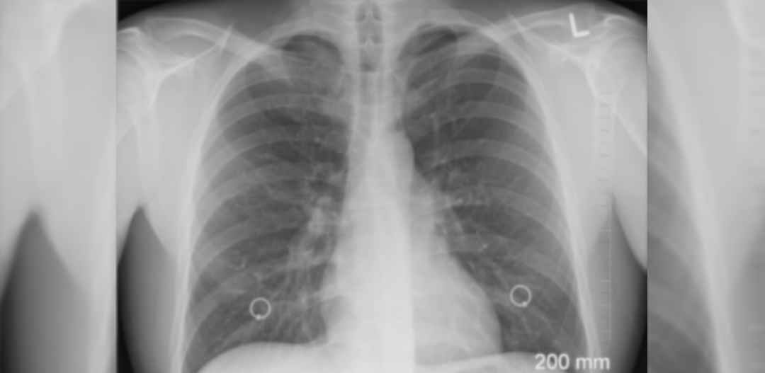 Jak COVID-19 niszczy płuca? Prof. Kuna: „Coraz częściej zapalenie płuc, narządy zniszczone w 100%”