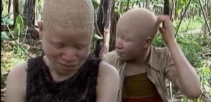 Albinosi w Afryce - czarna magia i brutalne polowania