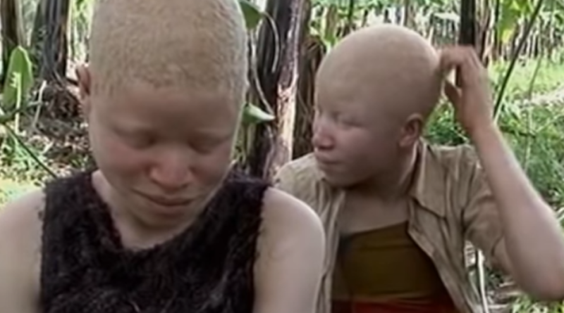 Albinosi w Afryce - czarna magia i brutalne polowania