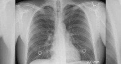 COVID-19 i zapalenie płuc. Lekarze ostrzegają jak koronawirus SARS-CoV-2 niszczy płuca