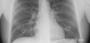 Tajemnicze zapalenie płuc w Argentynie. Czym wywołana jest zagadkowa choroba układu oddechowego?